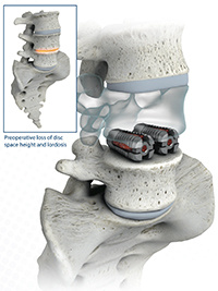 Spine surgeon South Carolina, Minimally invasive spine surgery, Artificial disc replacement Spine surgeon, second opinion, Herniated disc, Laser spine surgery, neurosurgery south Carolina, Second opinion for spine surgery, Home remedies for pain, Spine center of excellence South Carolina, orthopedic surgeon south carolina