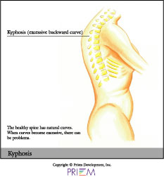Kyphosis
