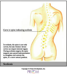 Scoliosis