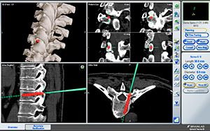 lumbar surgical navigation system south carolina, greenwood, south carolina spine center