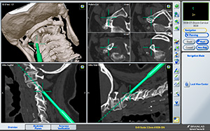 cervical surgical navigation system south carolina, greenwood, south carolina spine center