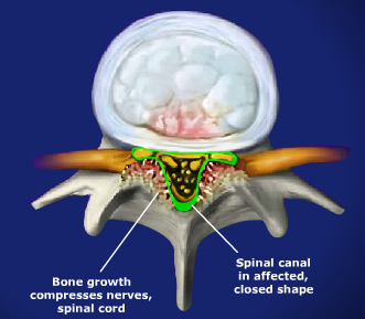 Stenosis
